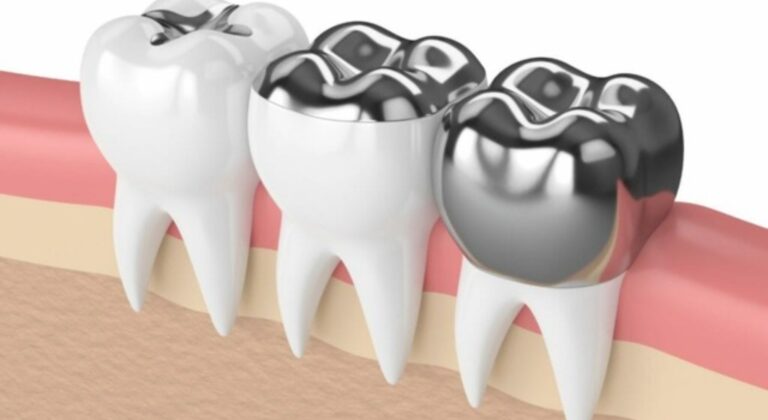 busting common myths about dental crowns