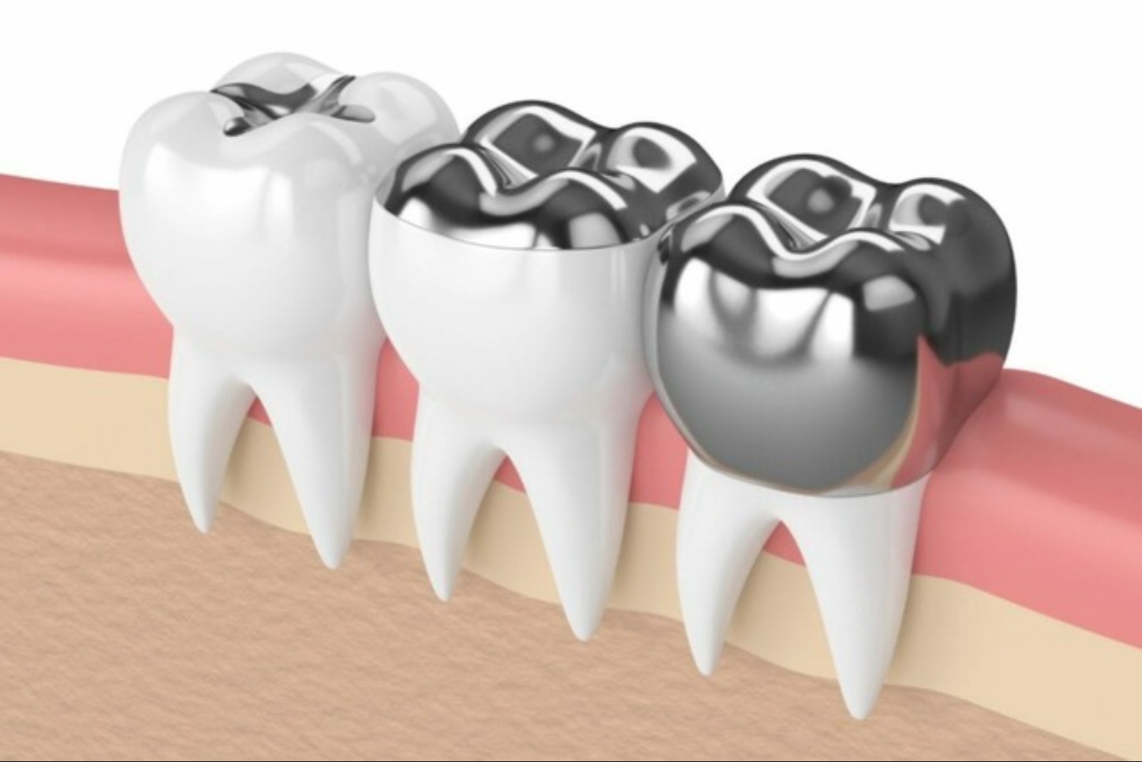 busting-common-myths-about-dental-crowns