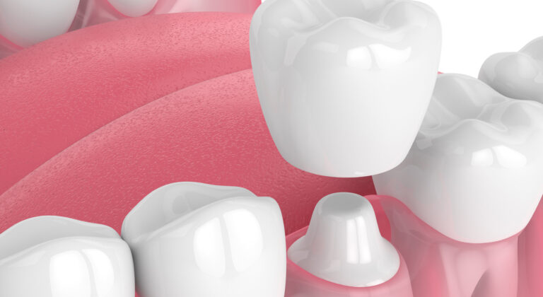 your guide to dental crowns