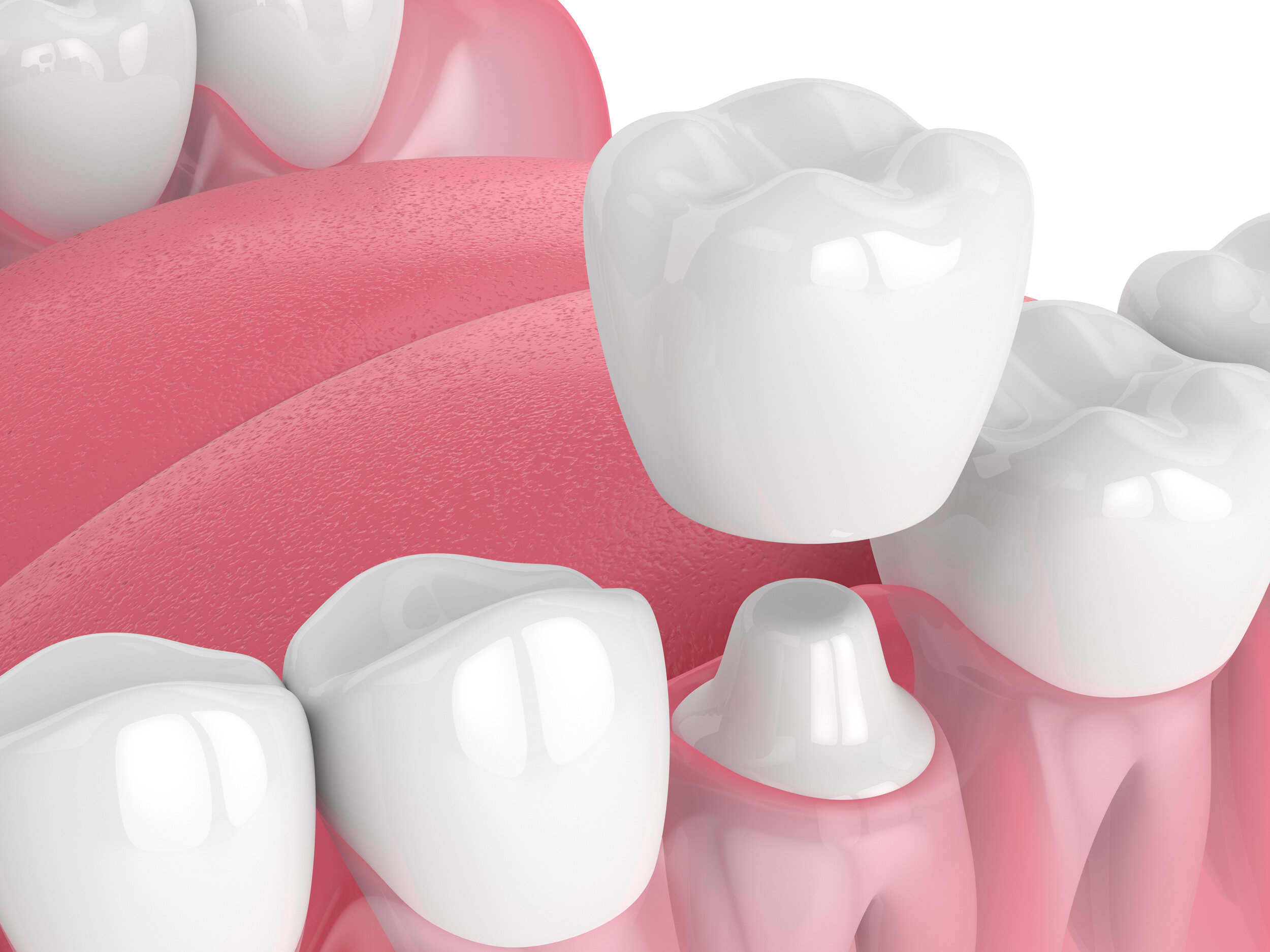 your guide to dental crowns